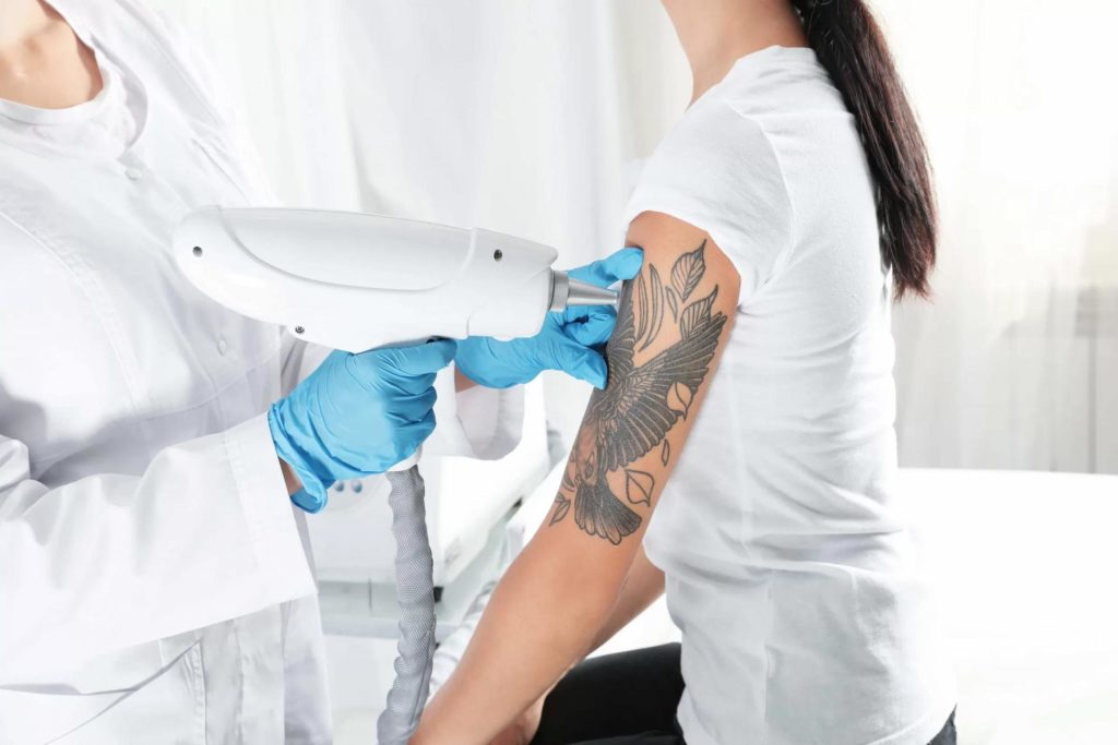 tattoo removal